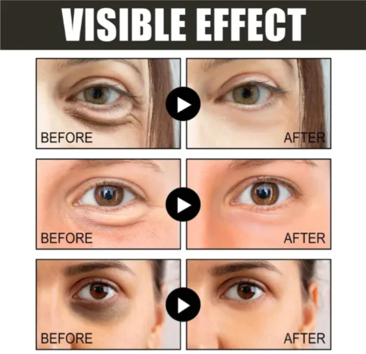 (🔥Vásárolj 1-et, kapsz 2-t ingyen🔥) Koffeines szemkörnyékápoló krém